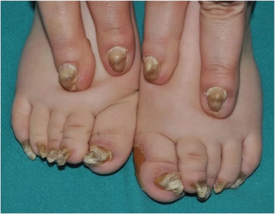 Two legs with Nail Dystrophy