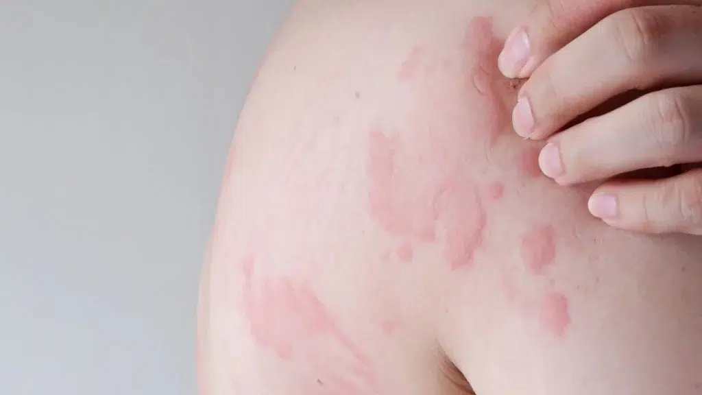 A part of the skin infected with Urticaria
