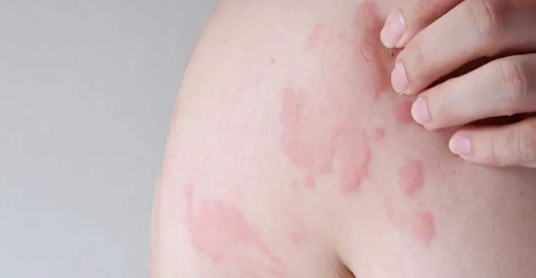 A part of the skin infected with Urticaria