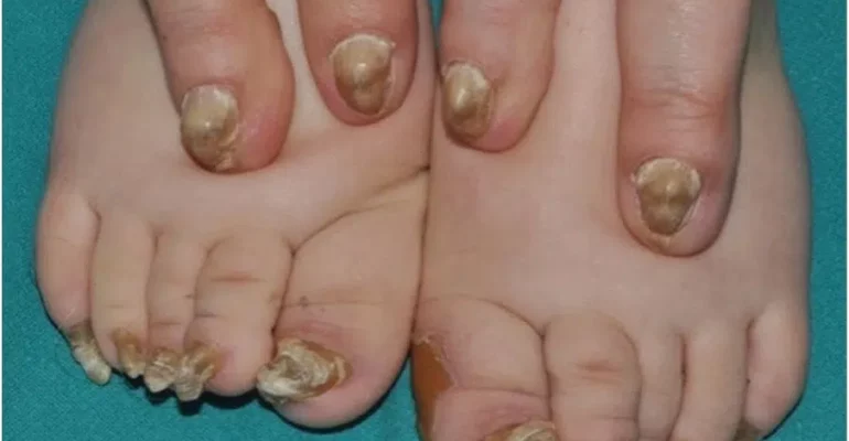 Two legs with Nail Dystrophy